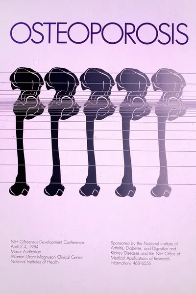 Osteoporosis by National Institutes of Health, 1984 — digital art print download
