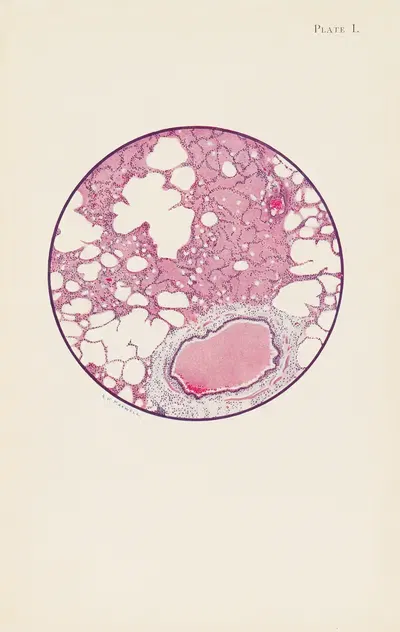 Plate I. Microscopic section of human lung from phosgene shell poisoning. Death at the nineteenth hour after gassing by A.…