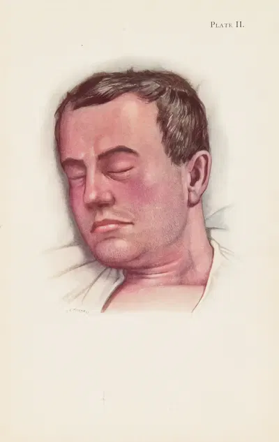 Plate II. Blue type of asphyxia from phosgene poisoning, with intense venous congestion by A. Kirkpatrick Maxwell, 1918 —…