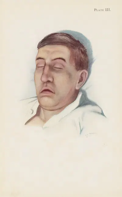Plate III. Pallid type of asphyxia from phosgene poisoning, with circulatory failure by A. Kirkpatrick Maxwell, 1918 —…