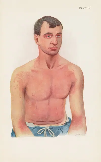 Plate V. Erythema of skin from general exposure to the vapour of Yellow Cross substance by A. Kirkpatrick Maxwell, 1918 —…
