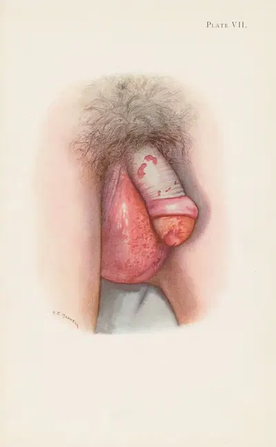 Plate VII. Burning of scrotum and penis by mustard gas by A. Kirkpatrick Maxwell, 1918 — digital art print download
