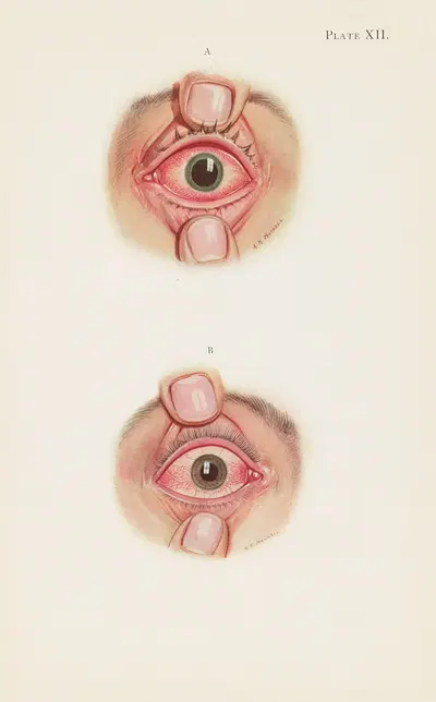 Plate XII. A. Stage of resolution after severe burning. B. Late stage of resolution by A. Kirkpatrick Maxwell, 1918 —…