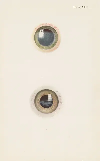 Plate XIII. A. Drawing of the cornea in the acute stage of severe burning. B. Drawing of cornea in the stage of resolution…