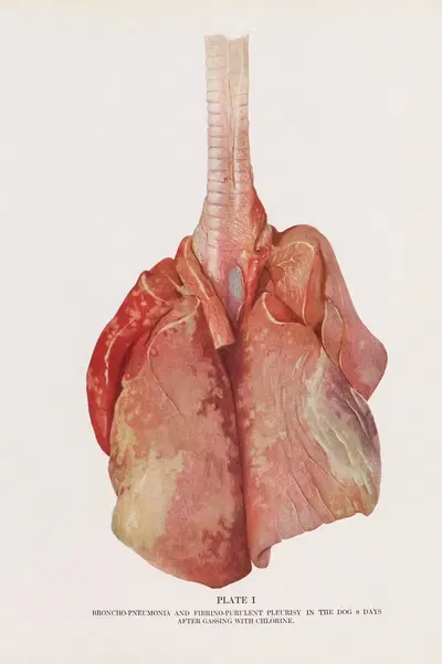 Plate I (Frontispiece): Broncho-pneumonia and fibrino-purulent pleurisy in a dog 8 days after gassing with chlorine. by…