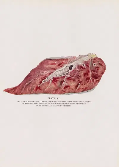 Plate XL (Fig. 1): Hemorrhages in lung of dog killed 10 days after phosgene gassing. by Milton C. Winternitz, 1920 —…