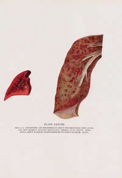 Plate XXXVIII (Figs. 8, 9): Congestion and hemorrhage about the bronchial tree standing out sharply against relatively…