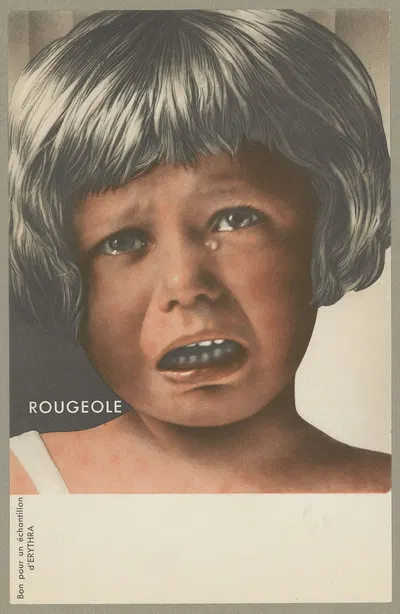 Rougeole (Erythra) by Société d'applications pharmacodynamiques, 1936 — digital art print download