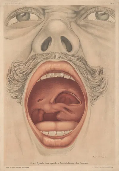 Дырки в небе, вызванные сифилисом by Верлаг фон Иоганн Амбросиус Барт, 1900 — digital art print download
