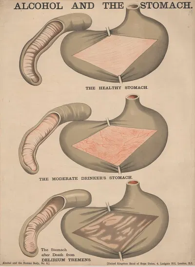 Alcohol and the Stomach by Charles Wakely, 1890 — digital art print download