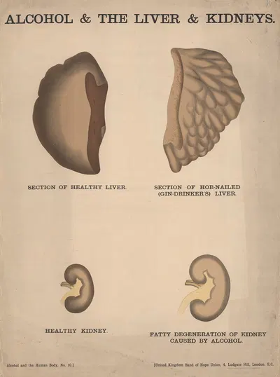 Alcohol & the Liver & Kidneys by Charles Wakely, 1890 — digital art print download