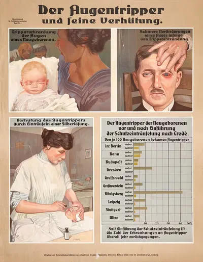 Окулярный гонорея и его профилактика by Д-р Тренклер и Ко, 1920 — digital art print download