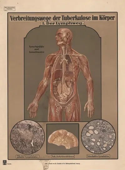 Пути передачи туберкулеза в организме. I. Лимфатическая система by Д-р Тренклер и Ко, 1920 — digital art print download