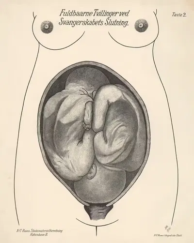 Full-term Twins at the End of Pregnancy by N.C. Rom, 1924 — digital art print download
