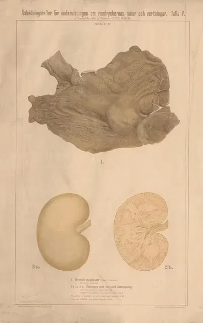 Chronic gastritis and fatty liver with early stages of cirrhosis by Anna Torell, 1904 — digital art print download