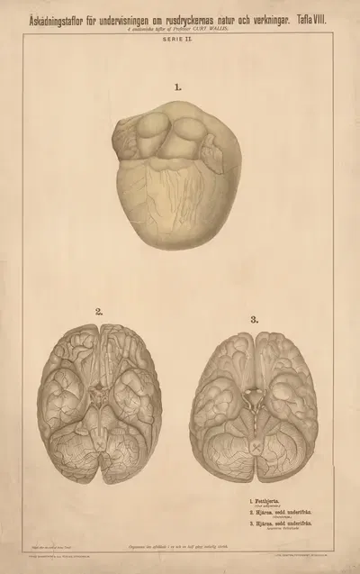 Fatty heart, healthy brain and calcified brain by Anna Torell, 1904 — digital art print download