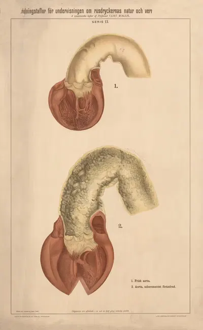 Healthy aorta and unhealthy aorta by Anna Torell, 1904 — digital art print download