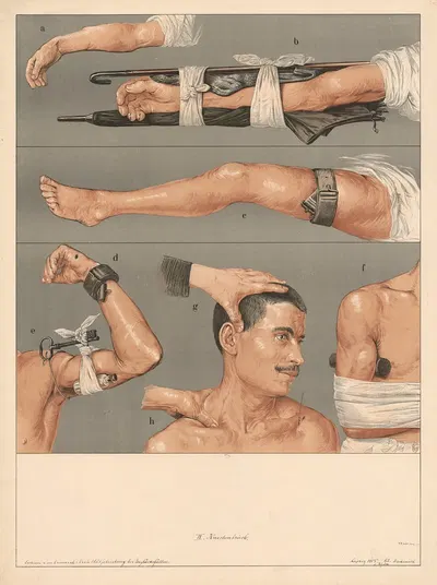 Knochenbruch by Max Eschner, 1905 — digital art print download