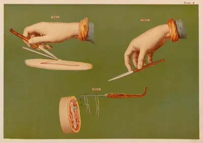 Методы держания бистури, перевязка артерии на пеньке by Элиас Смит, 1889 — digital art print download
