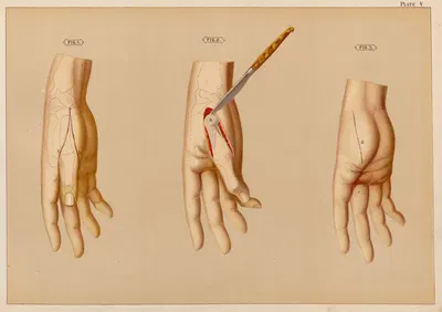 Дисарткуляция метакарпальной кости большого пальца by Элиас Смит, 1889 — digital art print download