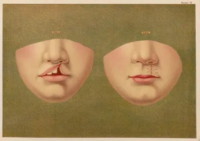 Заячья губа by Элиас Смит, 1889 — digital art print download