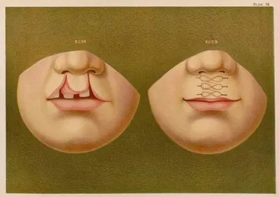 Двойной заячий губ by Элиас Смит, 1889 — digital art print download