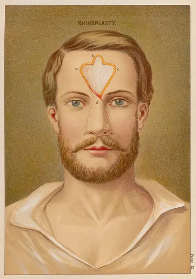 Ринопластика by Элиас Смит, 1889 — digital art print download