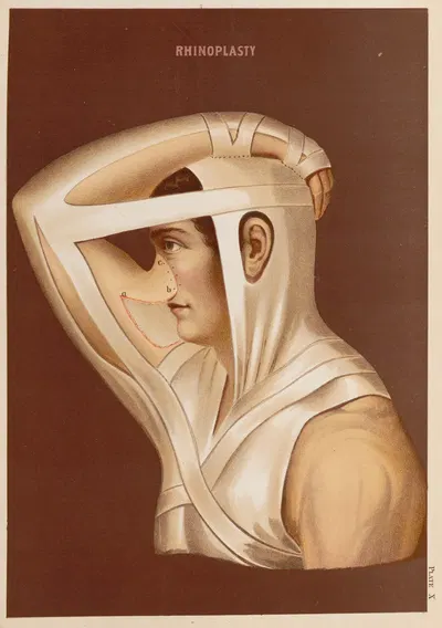Ринопластика by Элиас Смит, 1889 — digital art print download