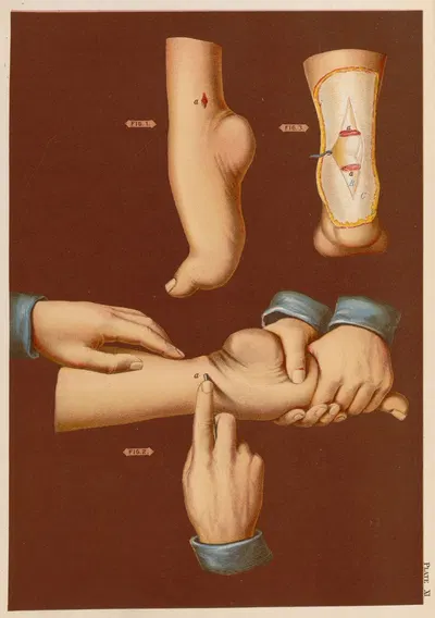 Сечение ахиллова сухожилия при equinus by Элиас Смит, 1889 — digital art print download