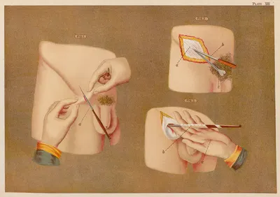 Грыжа by Элиас Смит, 1889 — digital art print download