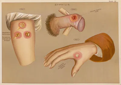 Сифилис by Элиас Смит, 1889 — digital art print download