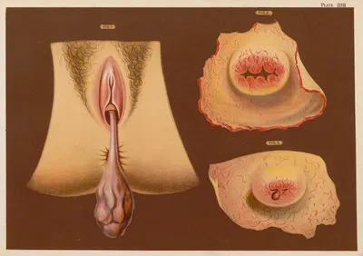 1. Педикулезные полипы 2. Щель шейки матки. 3. Везикулярные полипы by Элиас Смит, 1889 — digital art print download
