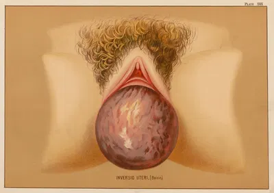 Инверсия матки by Элиас Смит, 1889 — digital art print download