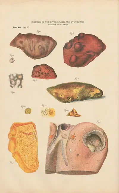 Cirrhosis of the liver,- infiltrations by Jean Allard Jeancon, 1888 — digital art print download