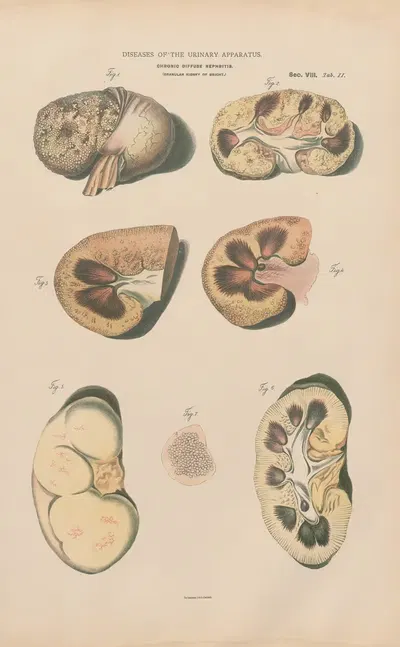 Chronic diffuse nephritis (Granular kidney) by Jean Allard Jeancon, 1888 — digital art print download