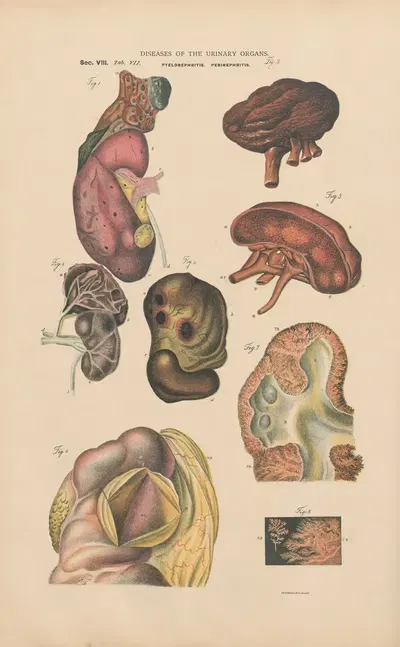 Pyelonephritis and extensive suppuration by Jean Allard Jeancon, 1888 — digital art print download