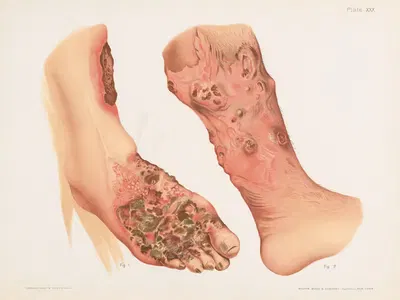 I. Syphilis cutanea ulcerosa et vegetans, II. Ulcero-gummous syphilide of the left leg in a twenty-two-year-old young man…