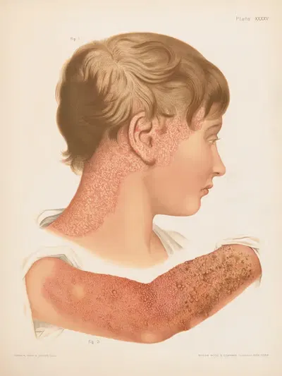 I. Eczema squamosum, II. Eczema papulosum, vesiculosum et impetiginosum by Prince Albert Morrow, 1888-1889 — digital art…