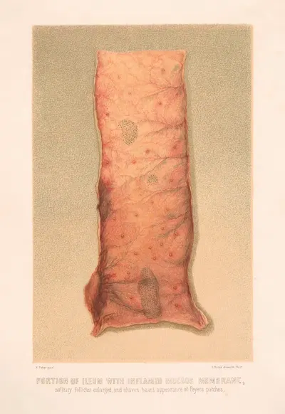 Portion of Ileum with inflamed mucus membrane by United States Surgeon-General's Office, 1870-1888 — digital art print…