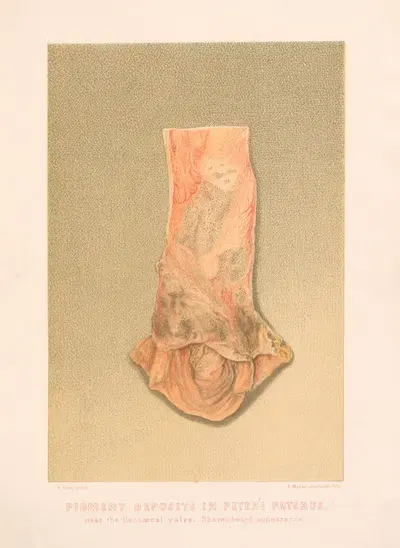 Pigment deposits in Peyer's patches, near the ileocaecal valve by United States Surgeon-General's Office, 1870-1888 —…