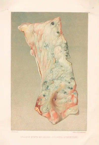 Colloid cysts of Colon-Chronic dysentry by United States Surgeon-General's Office, 1870-1888 — digital art print download