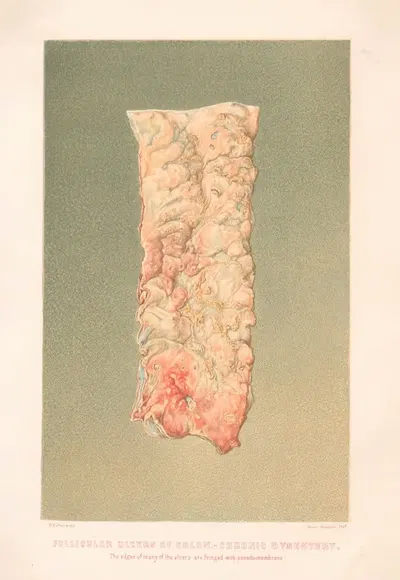Follicular ulcers of Colon-Chronic dysentry, The edges of many of the ulcers are fringed with pseudo-membrane by United…