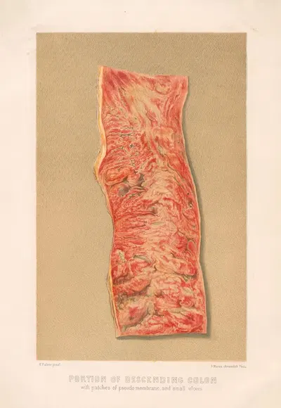 Portion of descending colon with patches of pseudo membrane, and small ulcers by United States Surgeon-General's Office,…