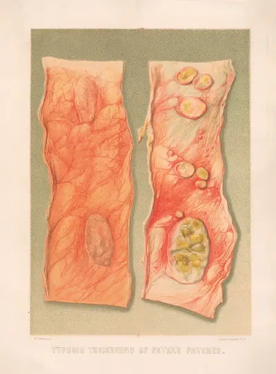 Typhoid thickening of Peyer's patches by United States Surgeon-General's Office, 1870-1888 — digital art print download