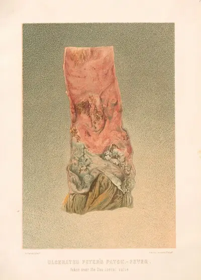Ulcerated Peyer's patch-fever taken near the Ileo-coecal valve by United States Surgeon-General's Office, 1870-1888 —…