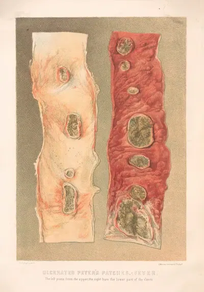 Ulcerated Peyer's patch-fever, The left piece from the upper, the right from the lower part of the ileum by United States…