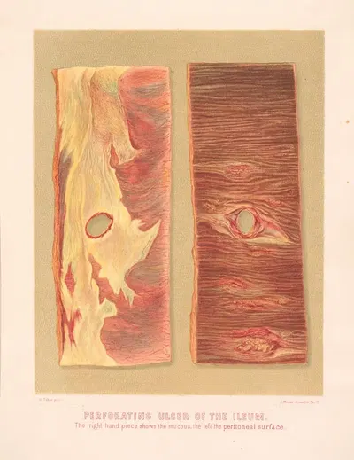 Perforating ulcer of the Ileum, The right hand piece shows the mucous, the left the peritoneal surface by United States…