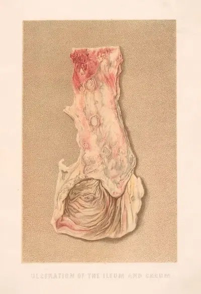 Ulceration of the Ileum and Caecum by United States Surgeon-General's Office, 1870-1888 — digital art print download