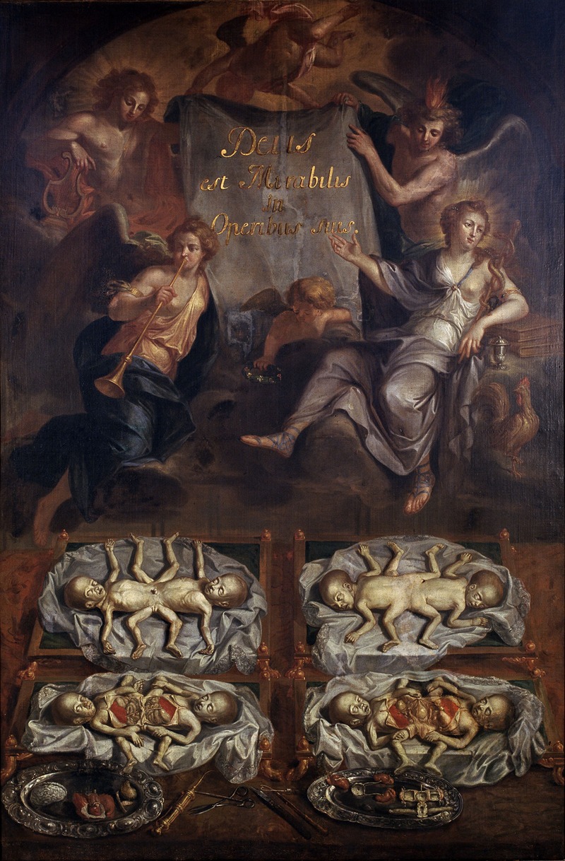 Dissection of Siamese Twins by Norbert Sauvage, 1703 — digital art print download