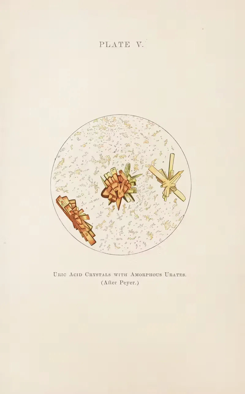 Plate V: Uric Acid Crystals with Amorphous Urates — Charles Wesley Purdy